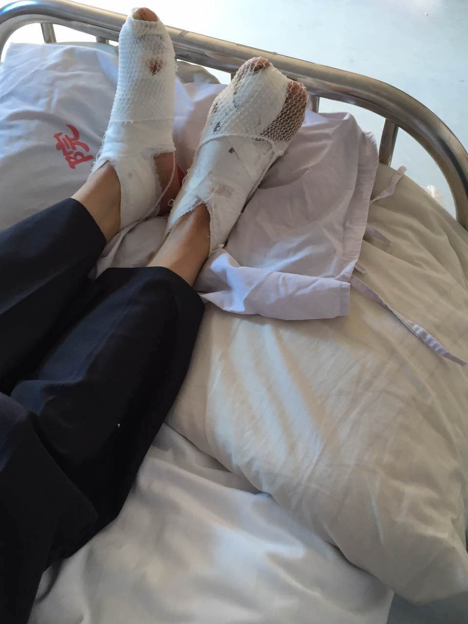 大脚骨病的微创手术_健康之路