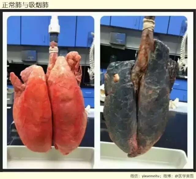 正常肺与吸烟肺的对比