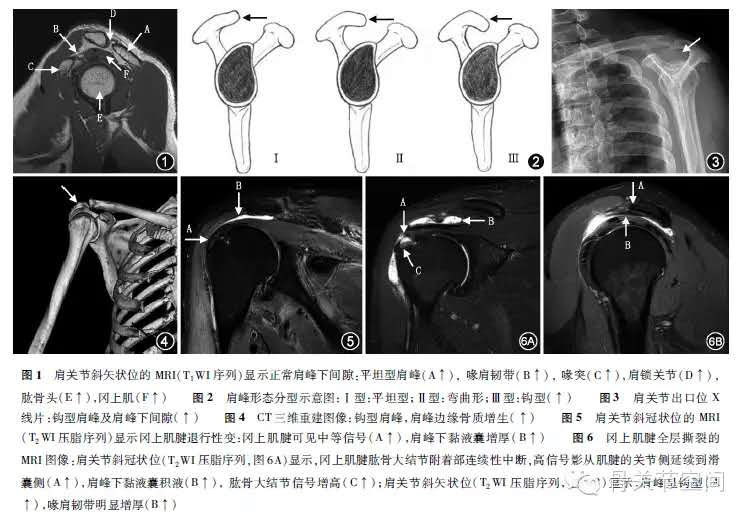 肩峰下撞击综合症影像学