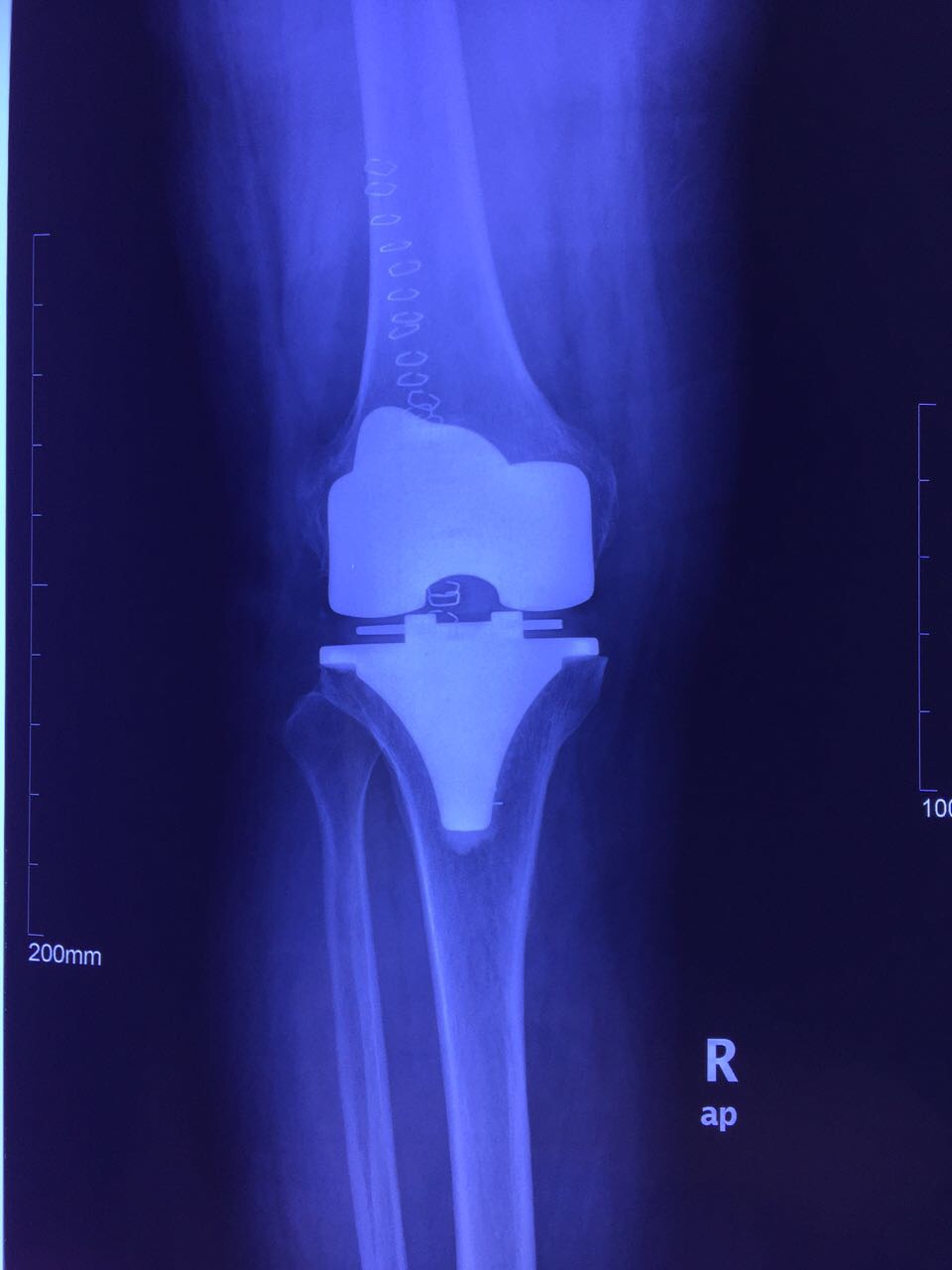 膝关节置换术后x线片