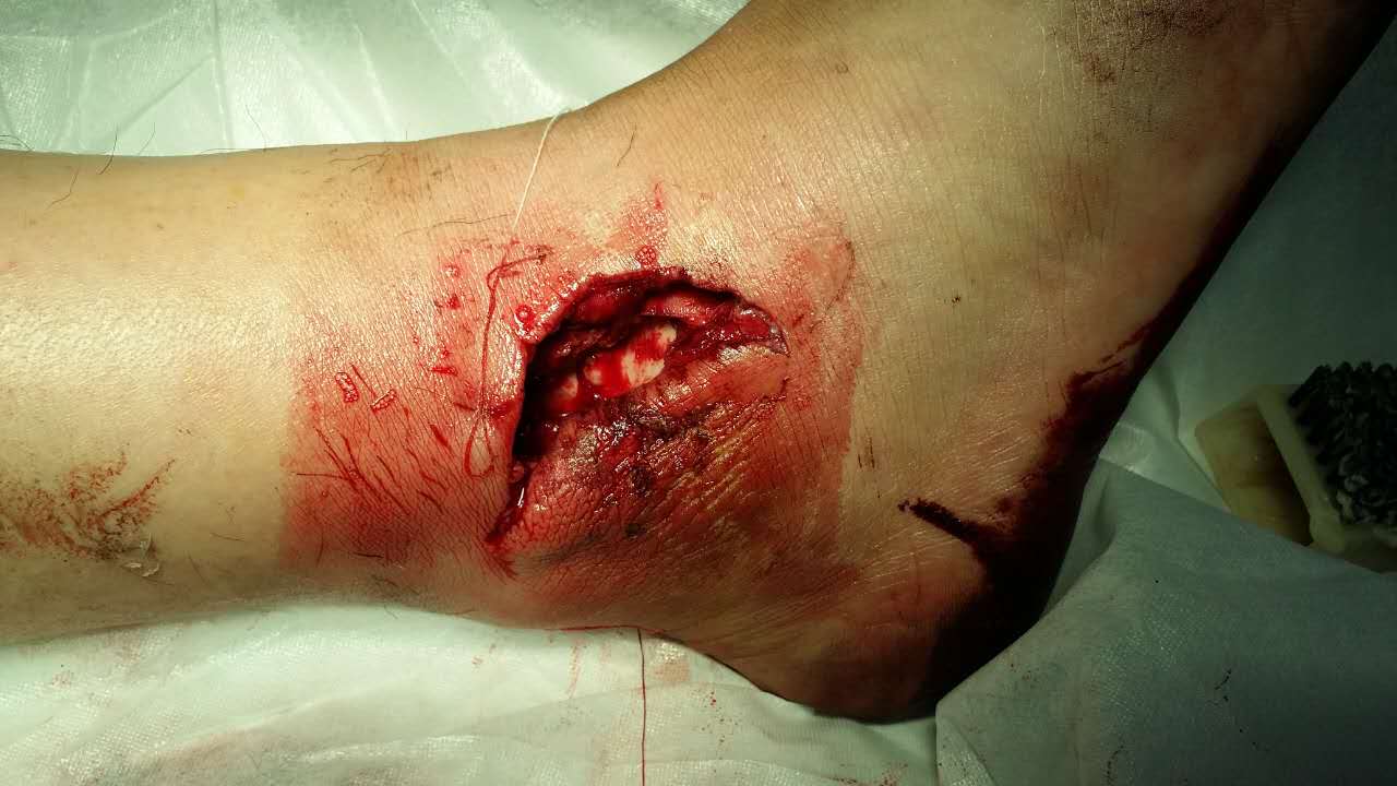 右外踝开放性粉碎性骨折伴踝关节外侧副韧带断裂