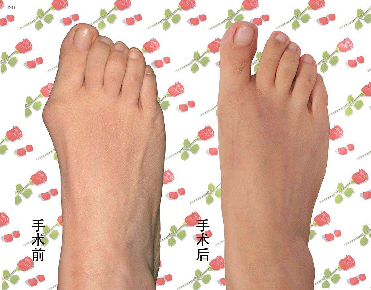 拇外翻手术效果2