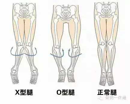 o型腿俗称罗圈腿,临床上又称膝内翻,x型腿医学上称膝外翻,主要因为