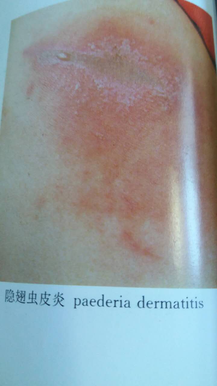 科普:隐翅虫皮炎