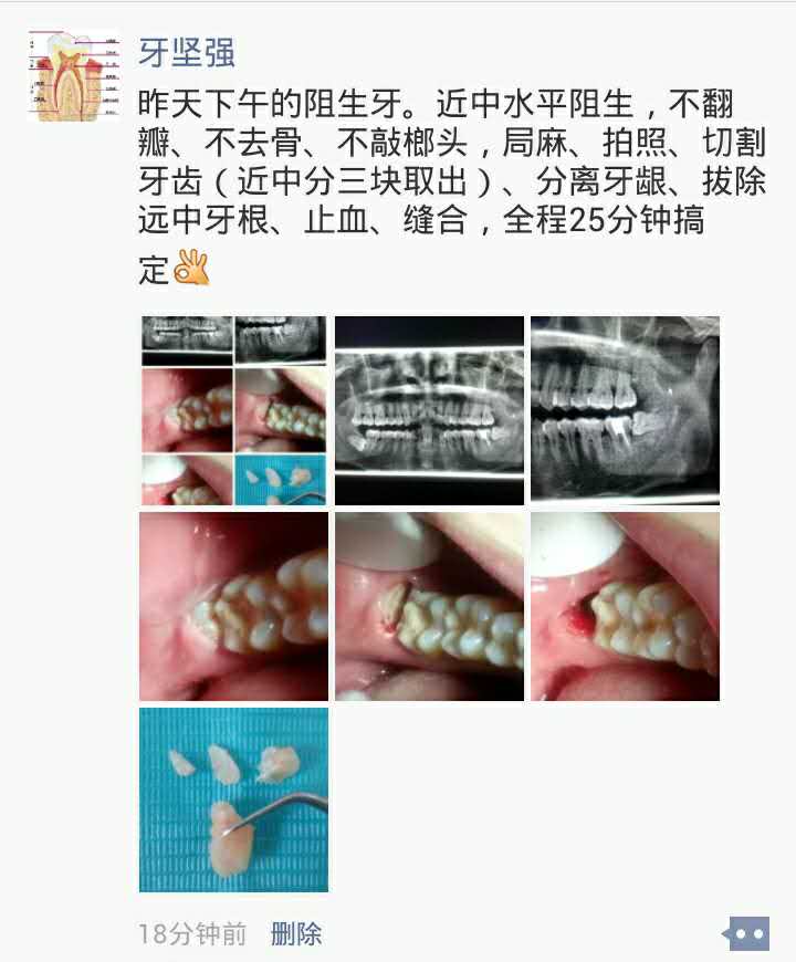 阻生牙微创拔除