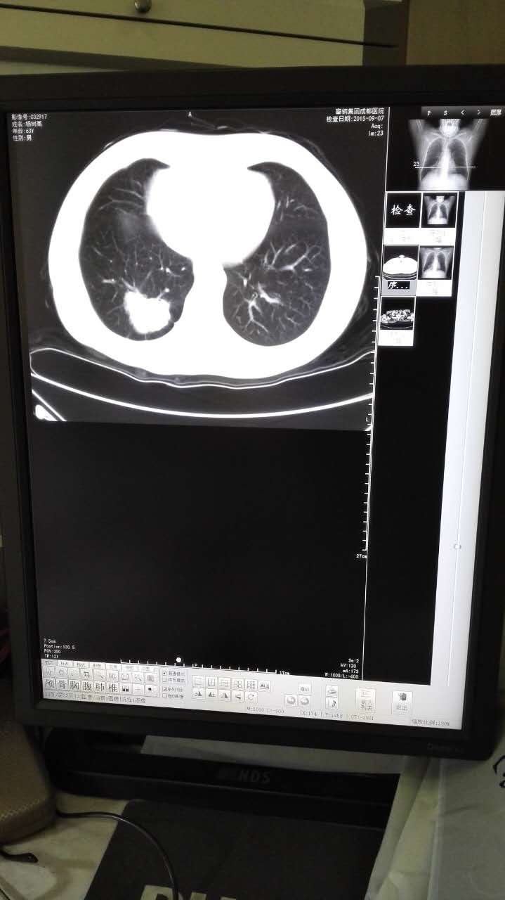 2,肺癌的早期诊断一一病例分享_健康之路