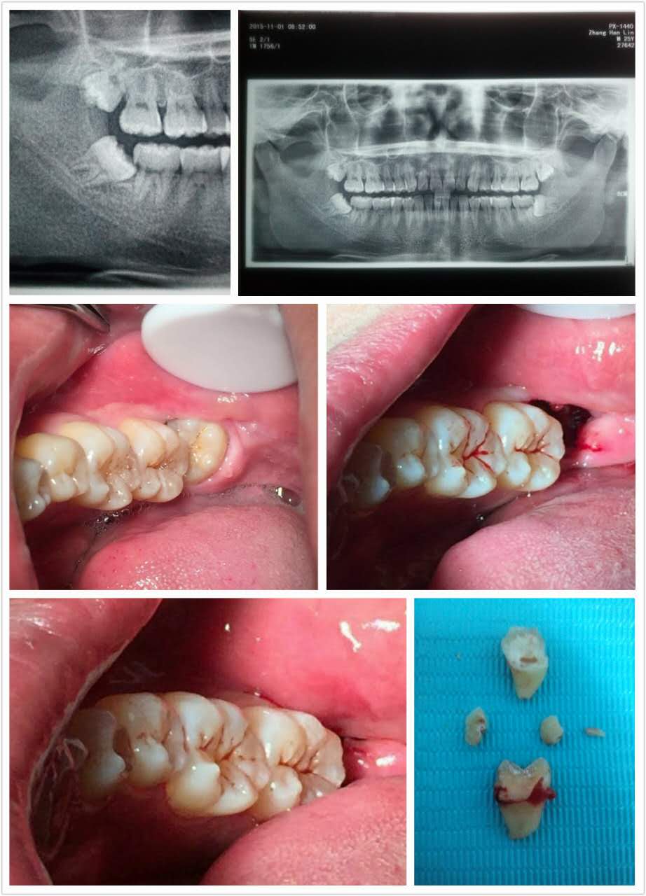 阻生牙微创拔除 2