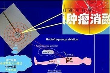 肝脏肿瘤的最新微创治疗方法"tace 微波射频消融术"