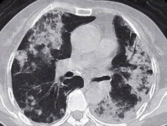 "双肺弥漫性浸润型肺癌" 的ct表现及鉴别诊断