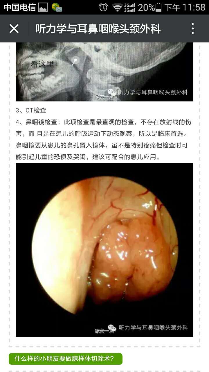 什么是腺样体?