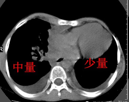 有关胸水定量的方法(x线,ct及超声)