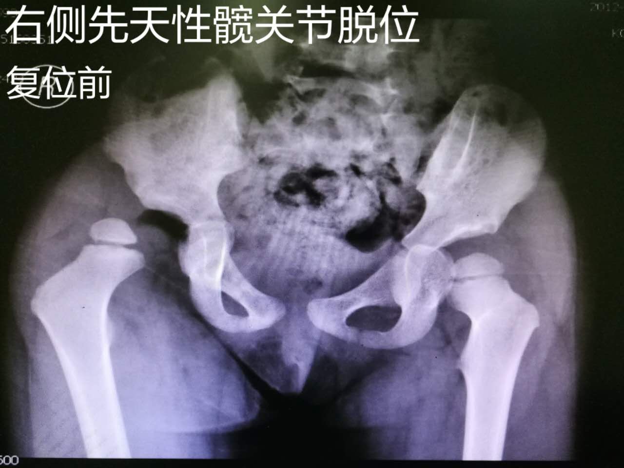 1例右侧先天性髋关节脱位治疗4年随访x片