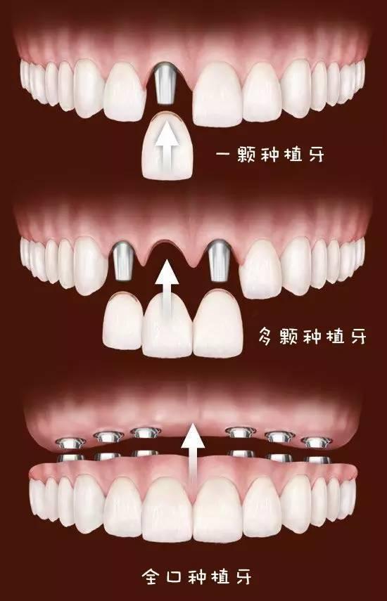 而长期缺牙的危害可是很大的: 牙列的完整性遭到破坏 牙齿缺失后,领近