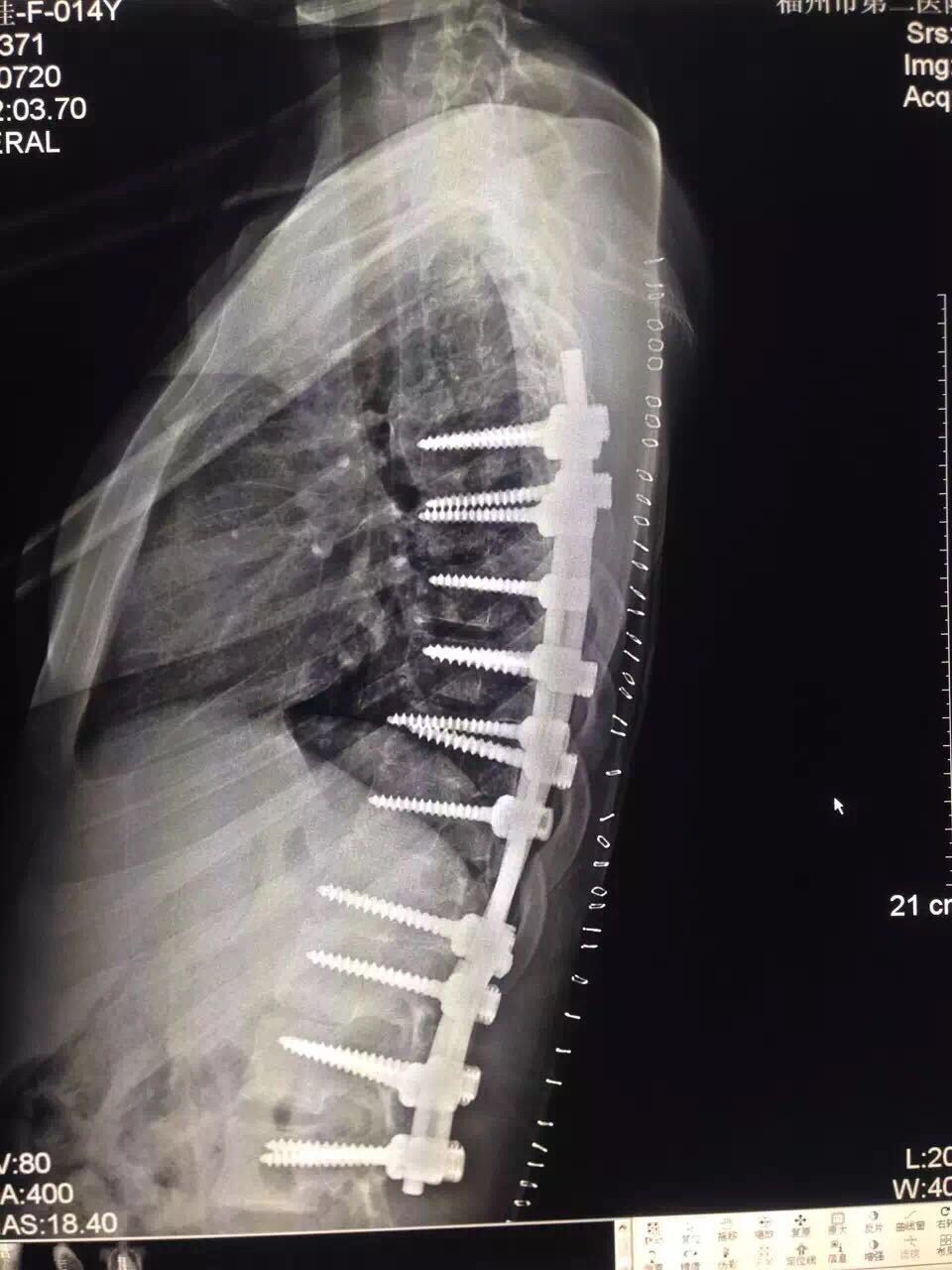合并脊髓空洞的青少年脊柱侧弯矫形手术