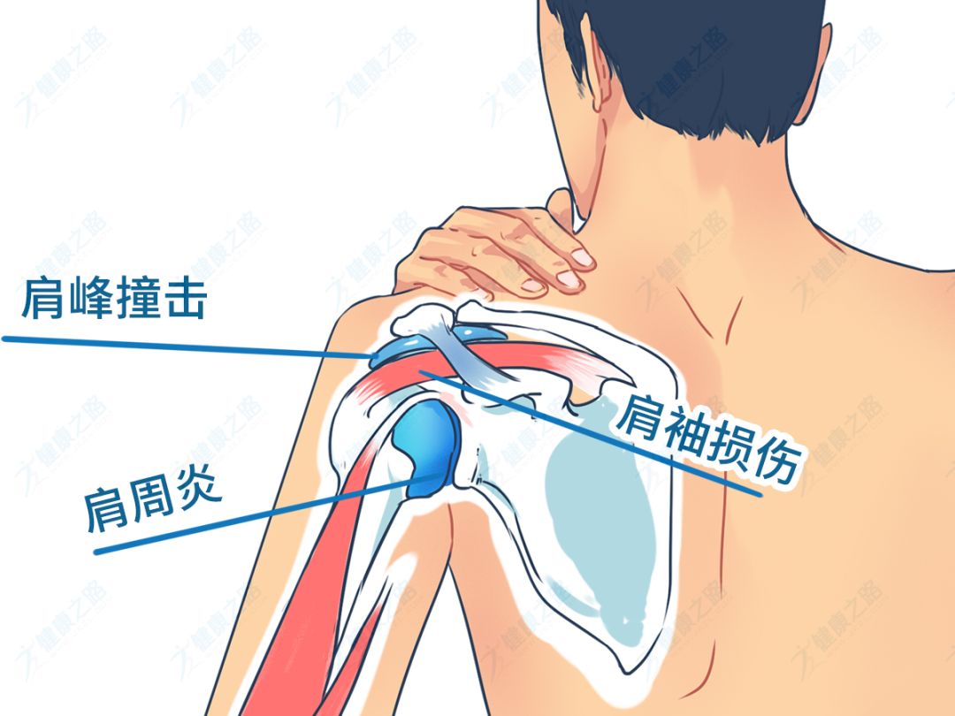 病因:肩部软组织退行病变;长期过度活动;肩周组织萎缩,粘连等.