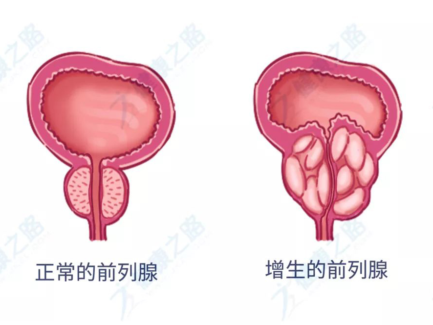 医生说|尿频尿急别怪肾!一表自测是否"前列腺增生"!