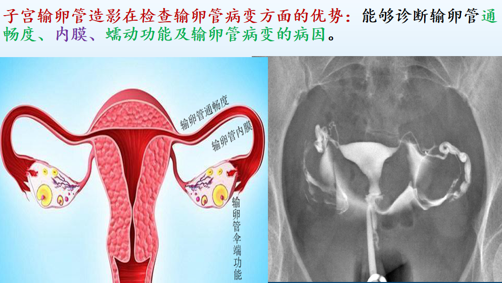 子宫输卵管造影检查多少钱?无痛子宫输卵管造影免费检查了!