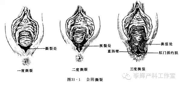 5,分娩过程中发生软产道裂伤,如宫颈裂伤,直肠粘膜裂伤及肛门括约肌