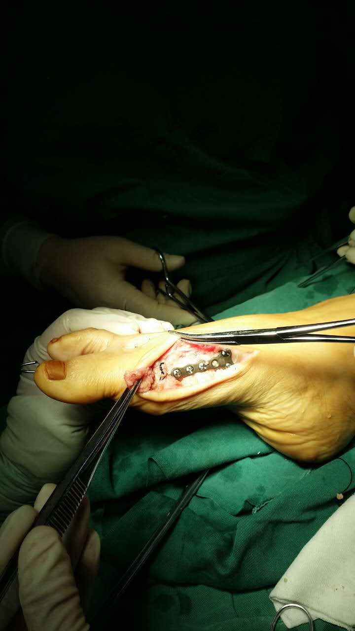 大脚骨手术过程图图片