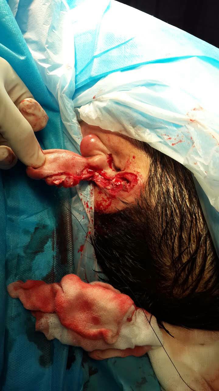 双耳严重挫伤病人,在我院术后恢复良好.