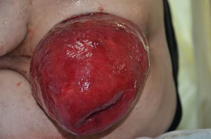 直肠黏膜脱垂图普