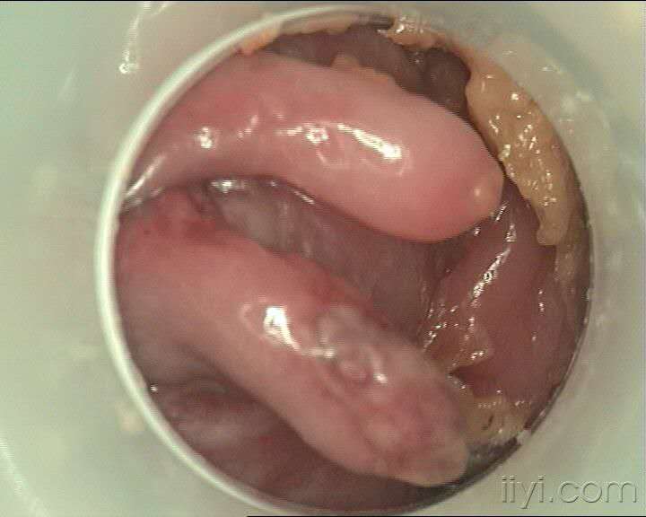 肛门口长个肉瘤图片图片