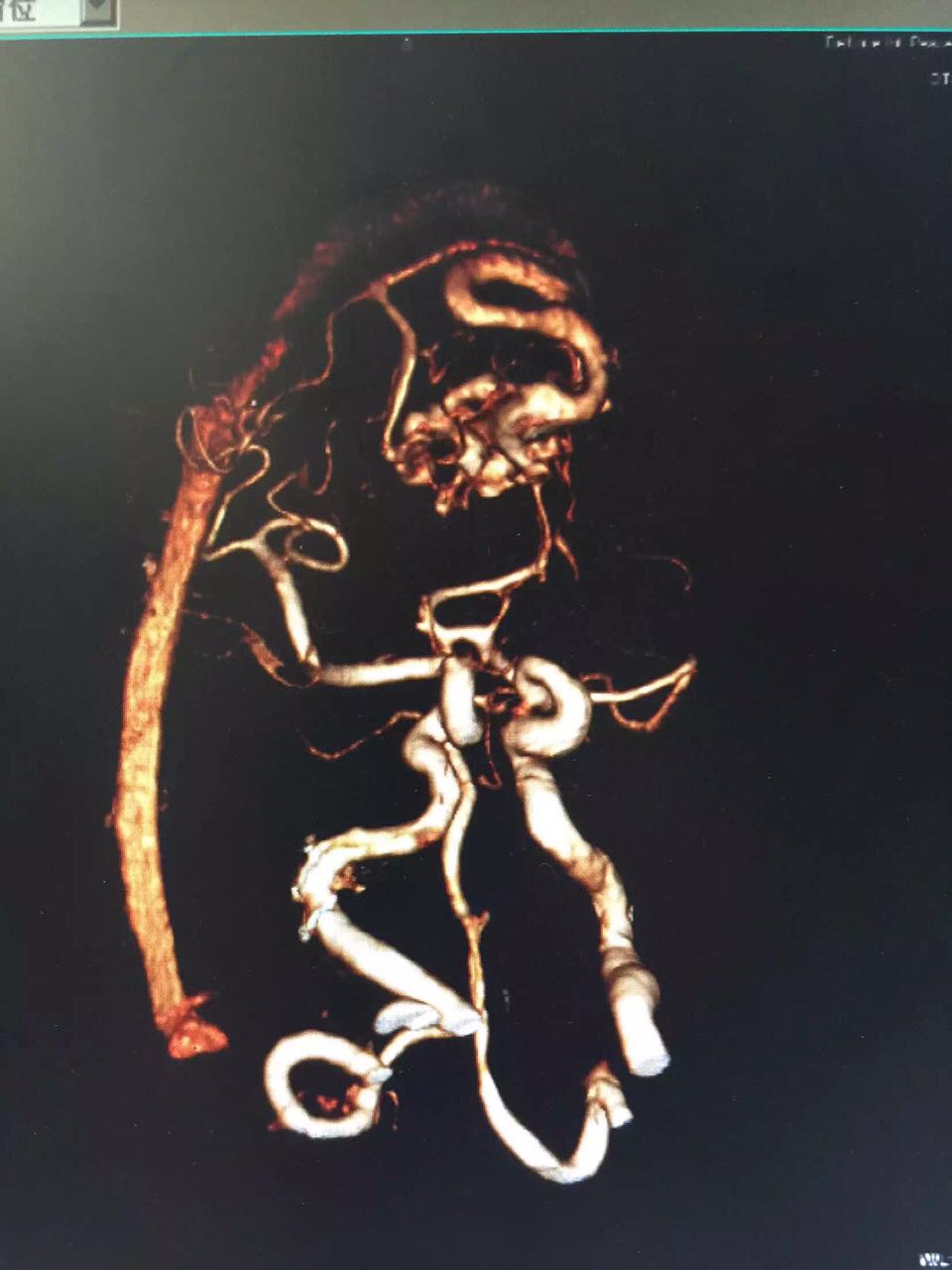 脑血管动静脉畸形(avm)切除
