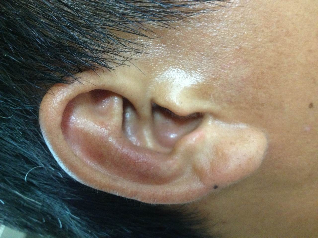 粉瘤 くりぬき法④ 耳前部 – まきのはら皮膚科
