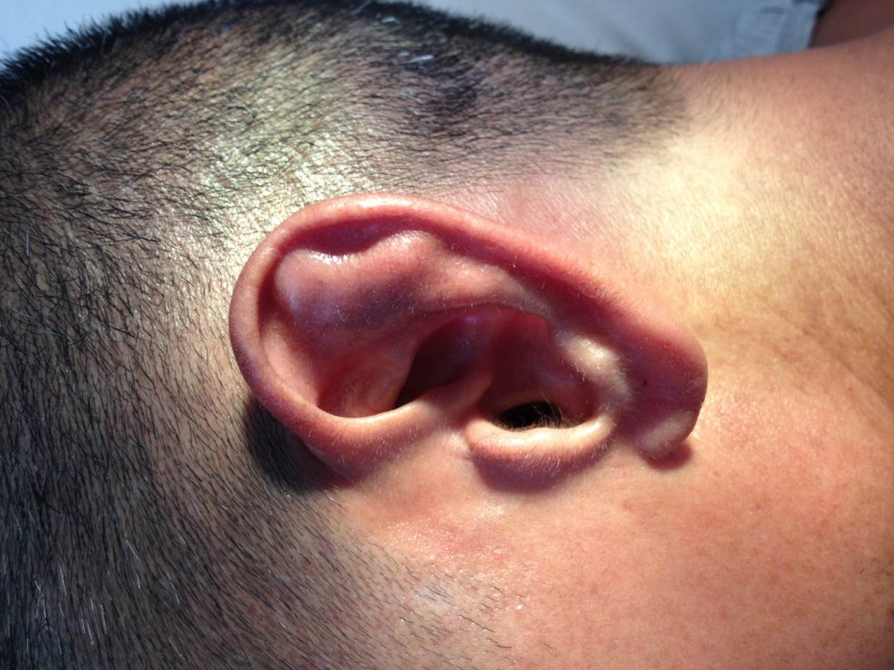 耳廓性假性囊肿图片