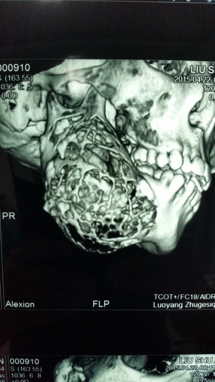 下颌骨巨大肿瘤切除十钛板重建