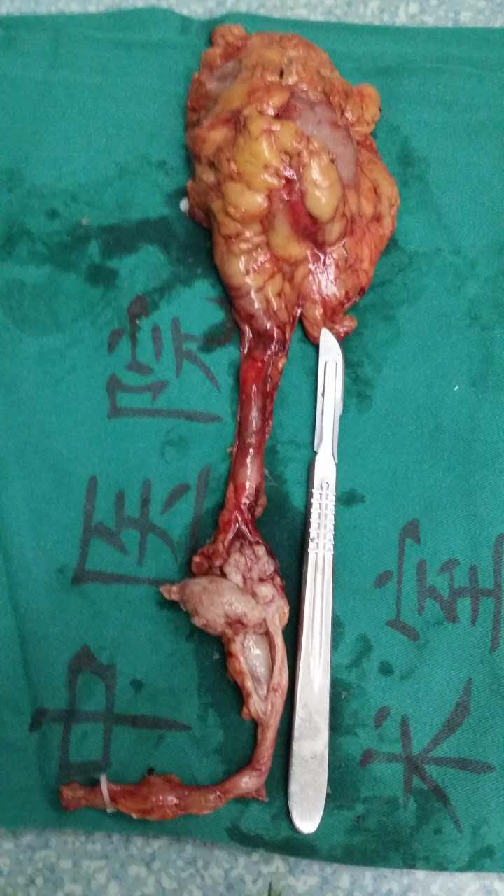 腹腔镜左输尿管癌根治术