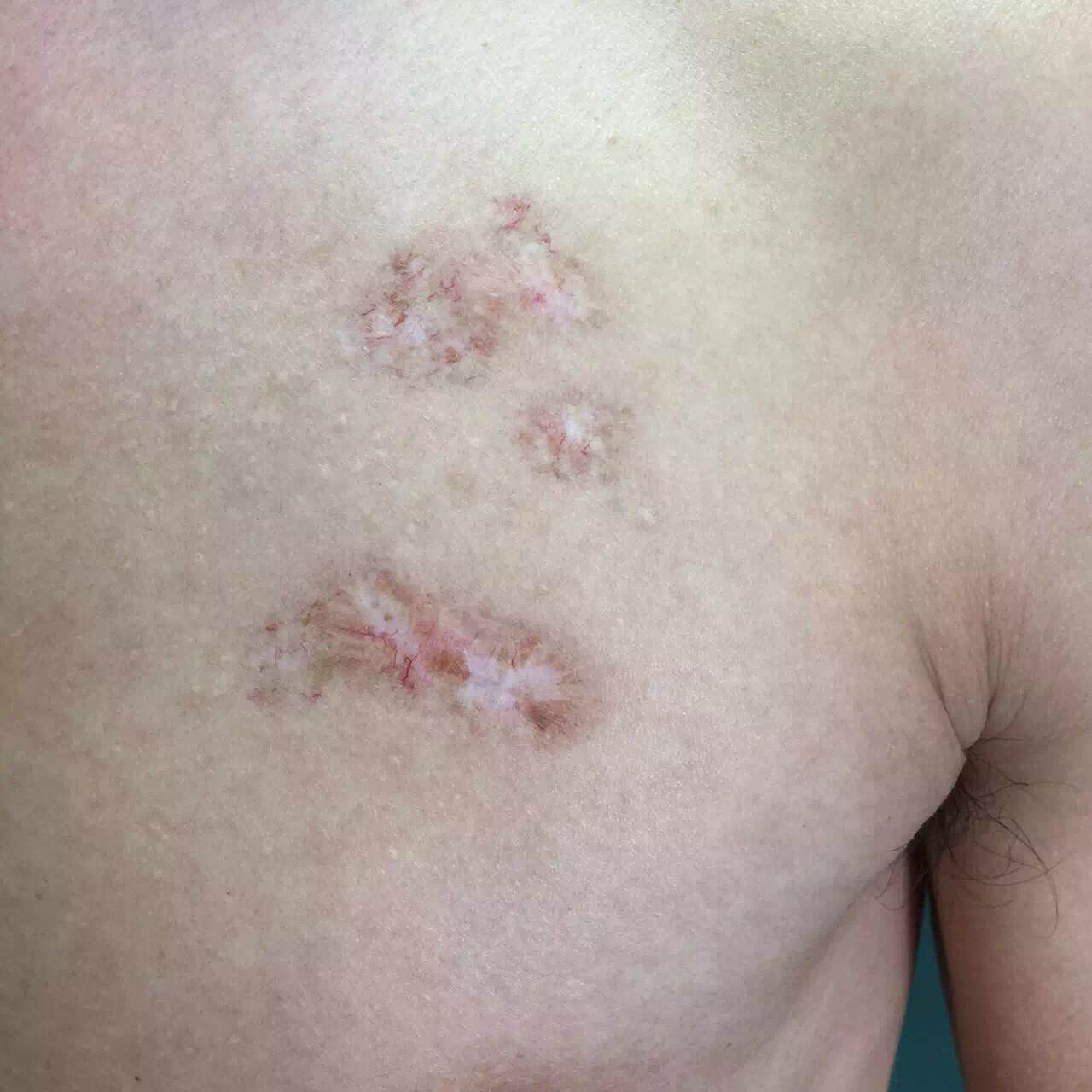 我科特色诊疗疤痕疙瘩同位素治疗