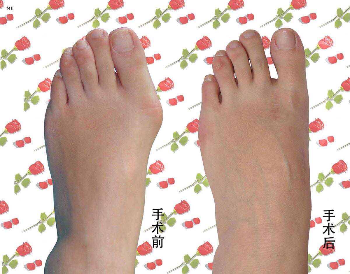 拇外翻手术效果2