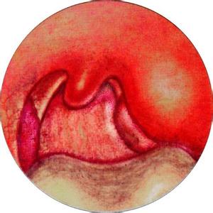 扁桃体表面瘢痕图片图片