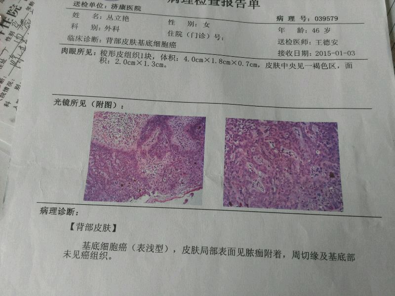 基底细胞癌病理诊断图片
