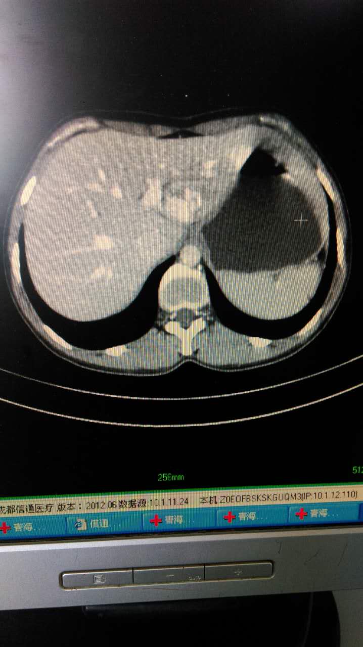 肝血管瘤ct片