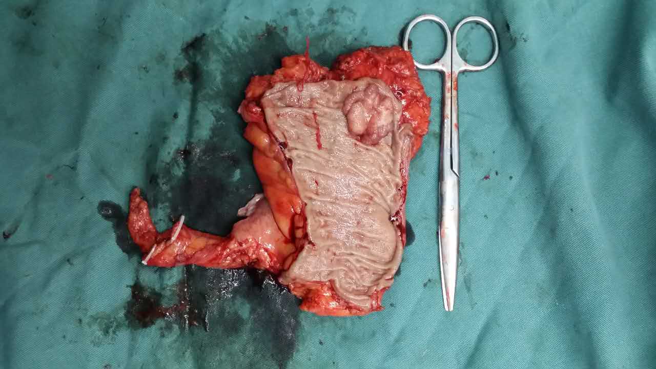 腹腔镜辅助直肠癌根治低位前切除术,手术标本.