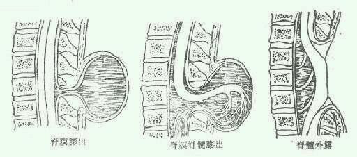 meningocele图片