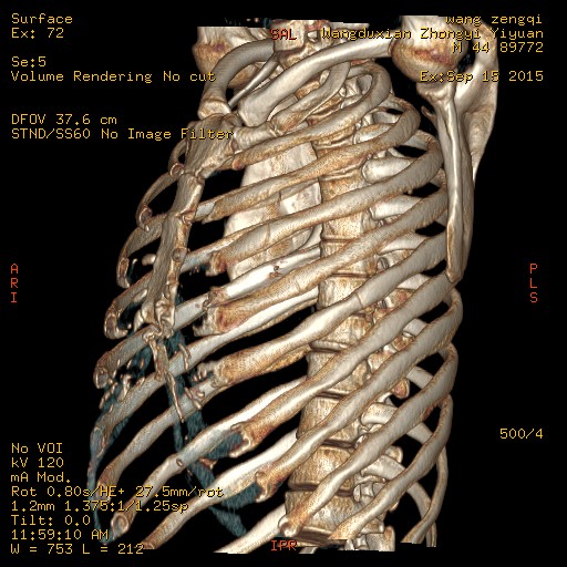 肋骨三维重建图片图片