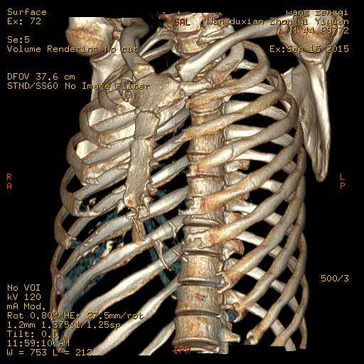 肋骨三维重建诊断肋骨骨折最可靠的方法