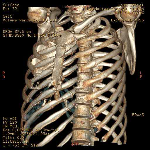 肋骨三维成像图片图片