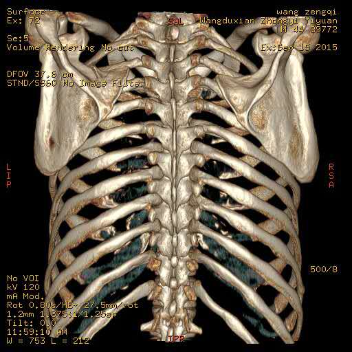 肋骨三维重建图片图片
