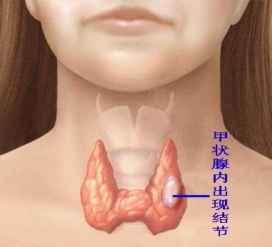 碘过量与甲状腺癌不能画等号