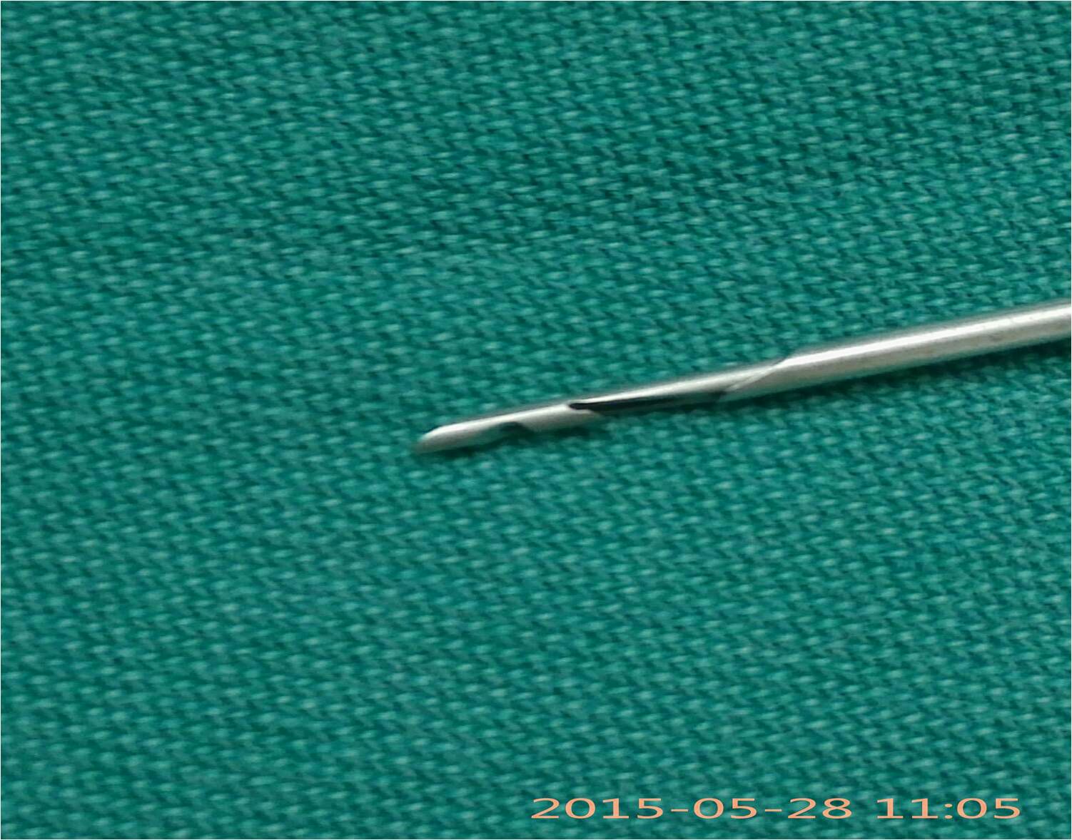 特殊器械-双沟针脐部切口置入腹腔镜,患侧下腹部置入双沟针术前诊断单