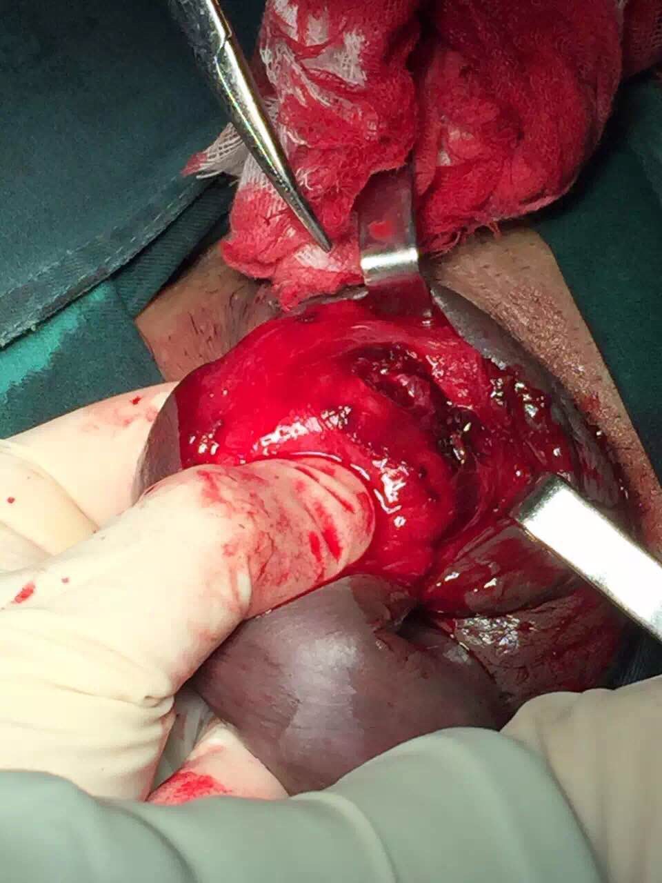 阴茎也会骨折哦!