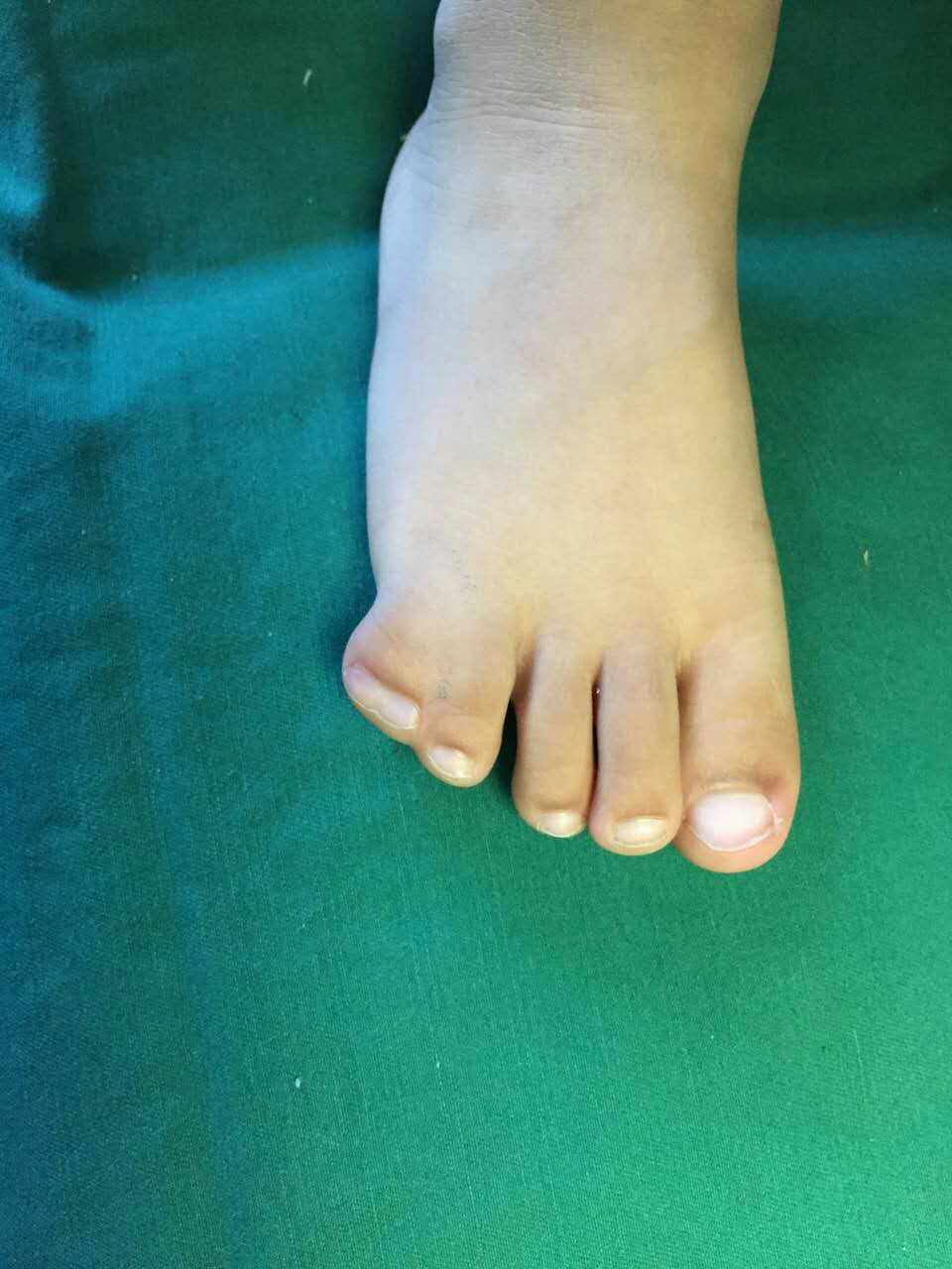 手足先天畸形的早期注意事项