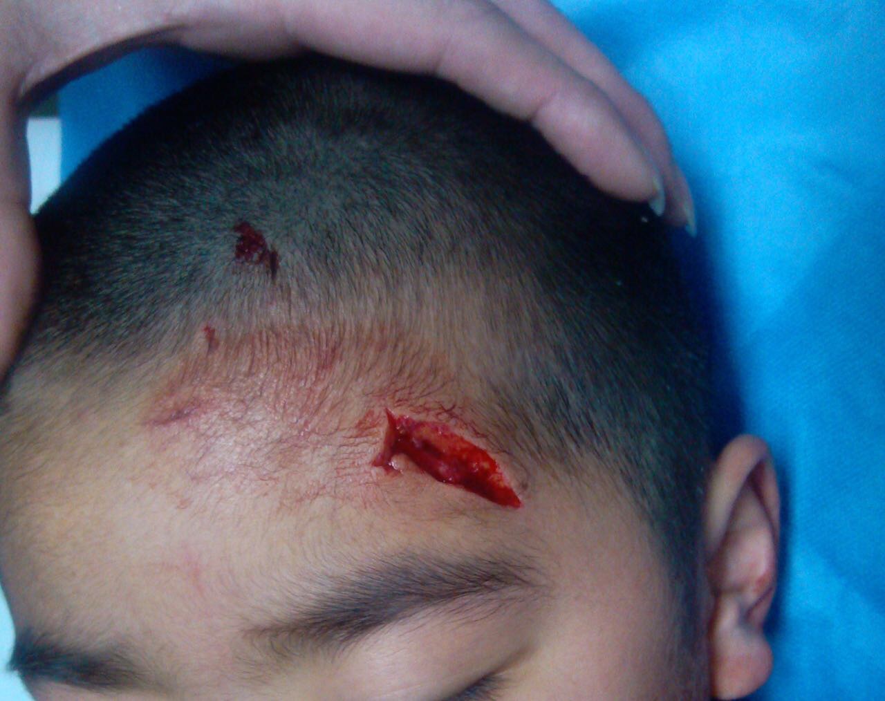 儿童颜面部外伤最专业的整形修复