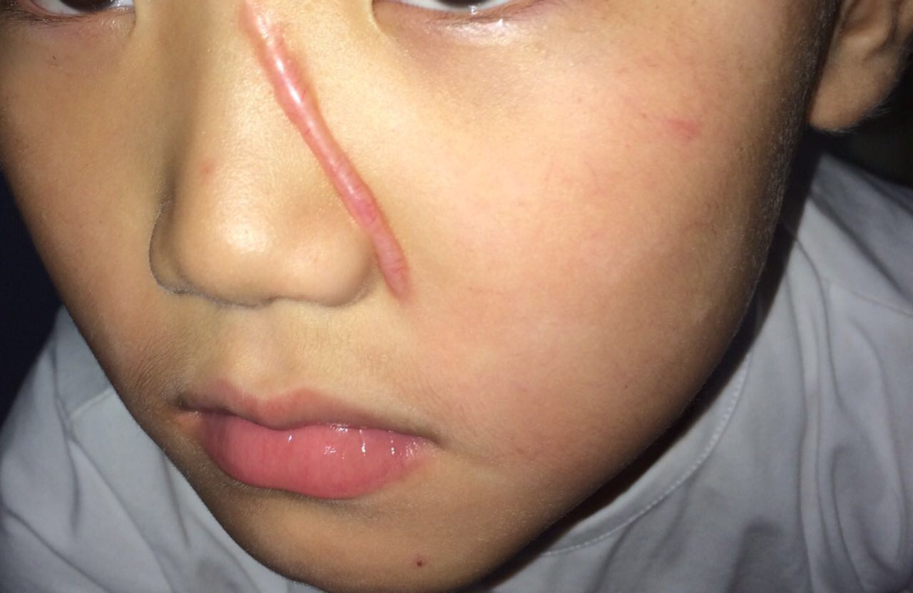 儿童颜面部外伤最专业的整形修复