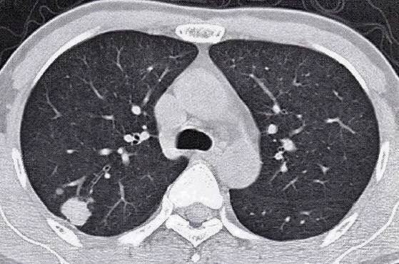 容易与肺癌发生混淆的 肺结核 见于这 四种 情况