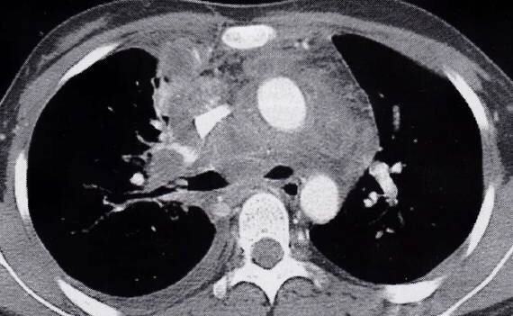 肺门淋巴结结核图片